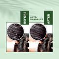 Anti-Dandruff Oil | Rejuvenate Your Scalp, Rediscover Confidence - 100ml